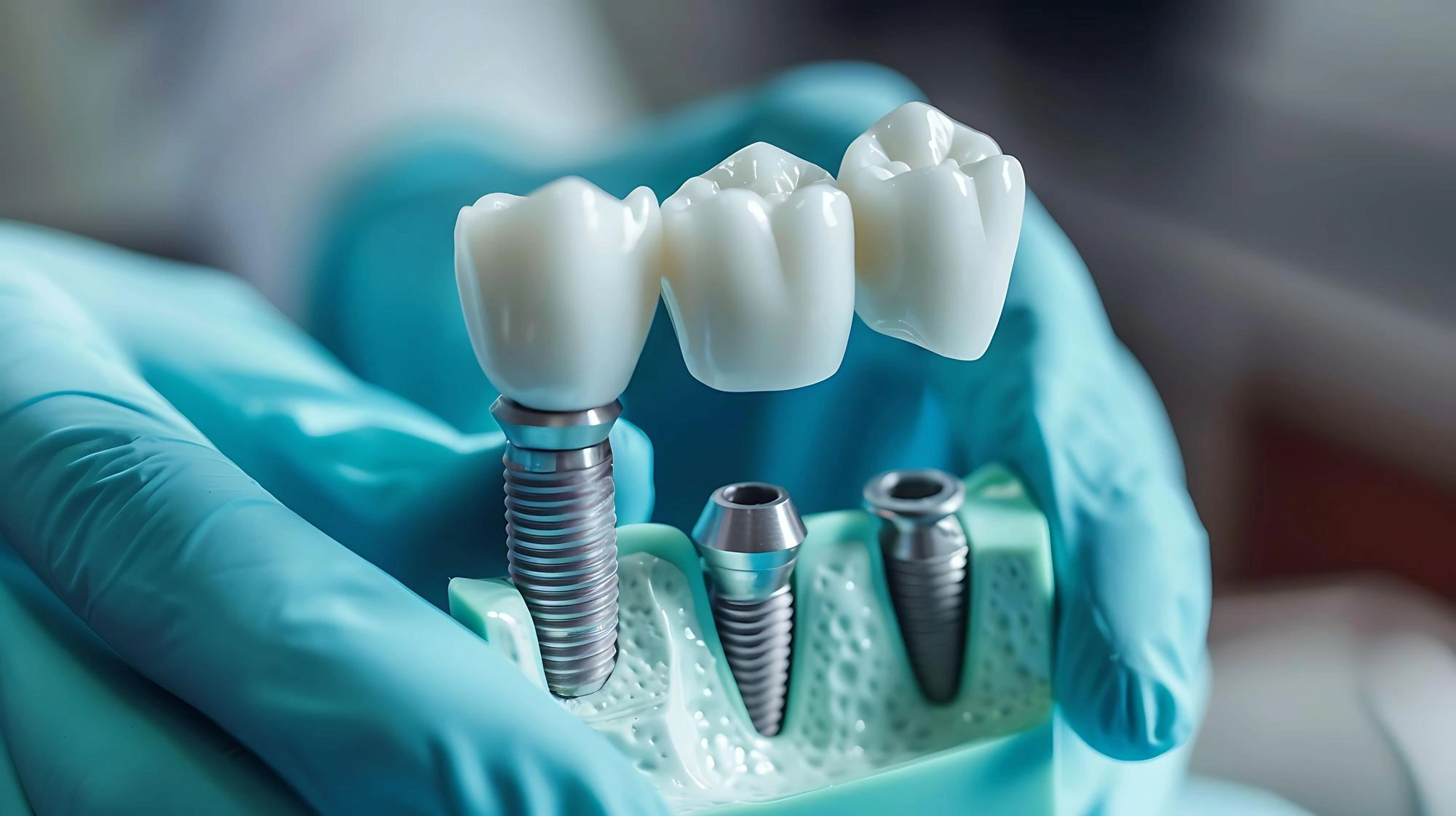 Benefits of Dental Implants