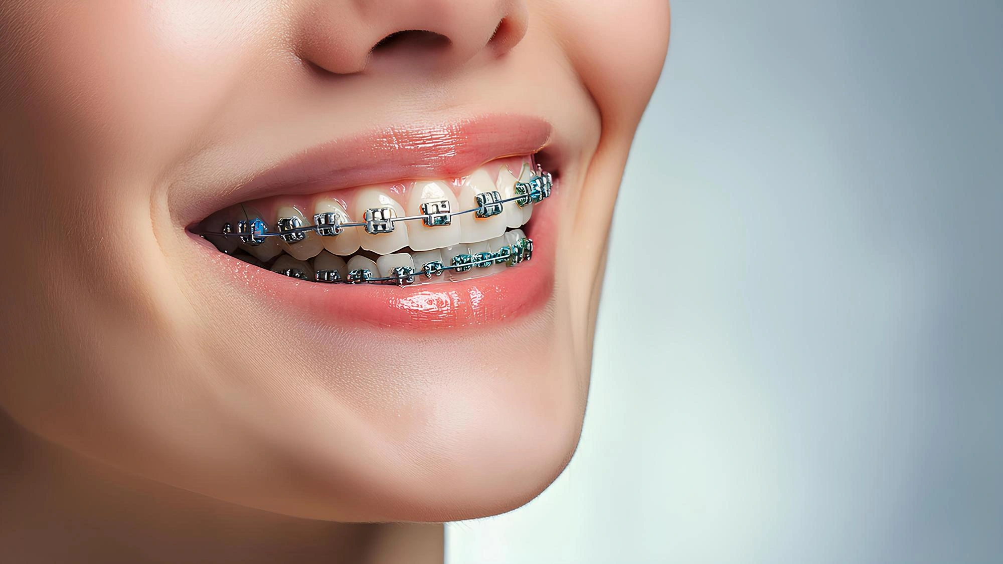 Dental Braces: A Time-Tested Solution for Straightening Smiles