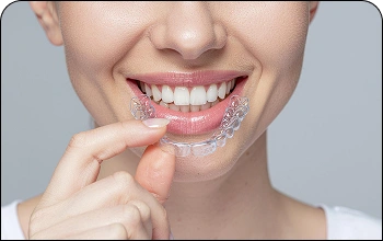 Illustration of clear aligners on upper teeth for discreet orthodontic treatment.