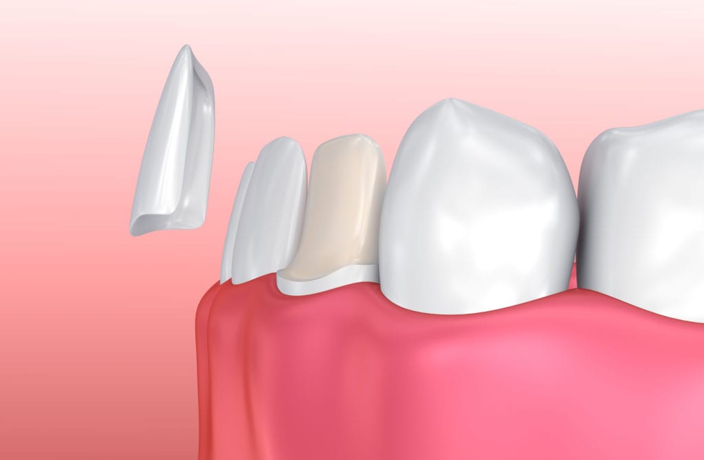 teeth whitening in chennai