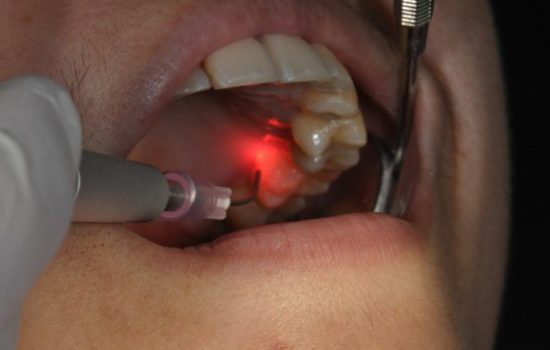 Best Laser Dental Clinic in Chennai