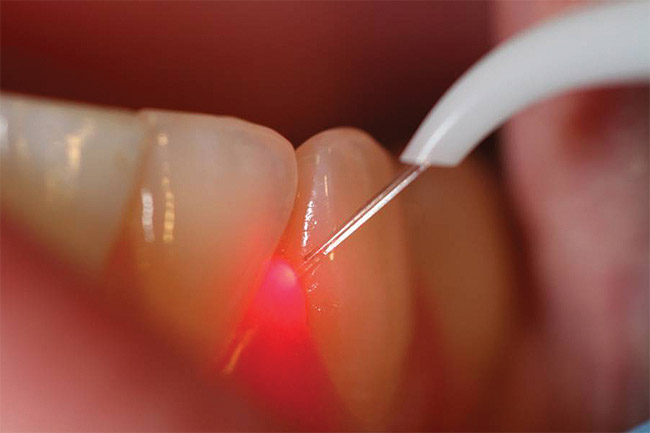 Laser Dentistry at Deepak Victor