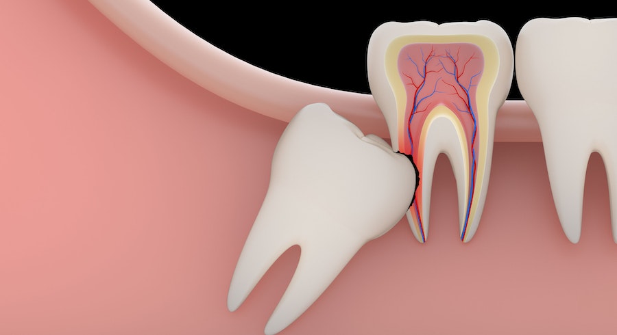 Tooth Removal Treatment in Chennai