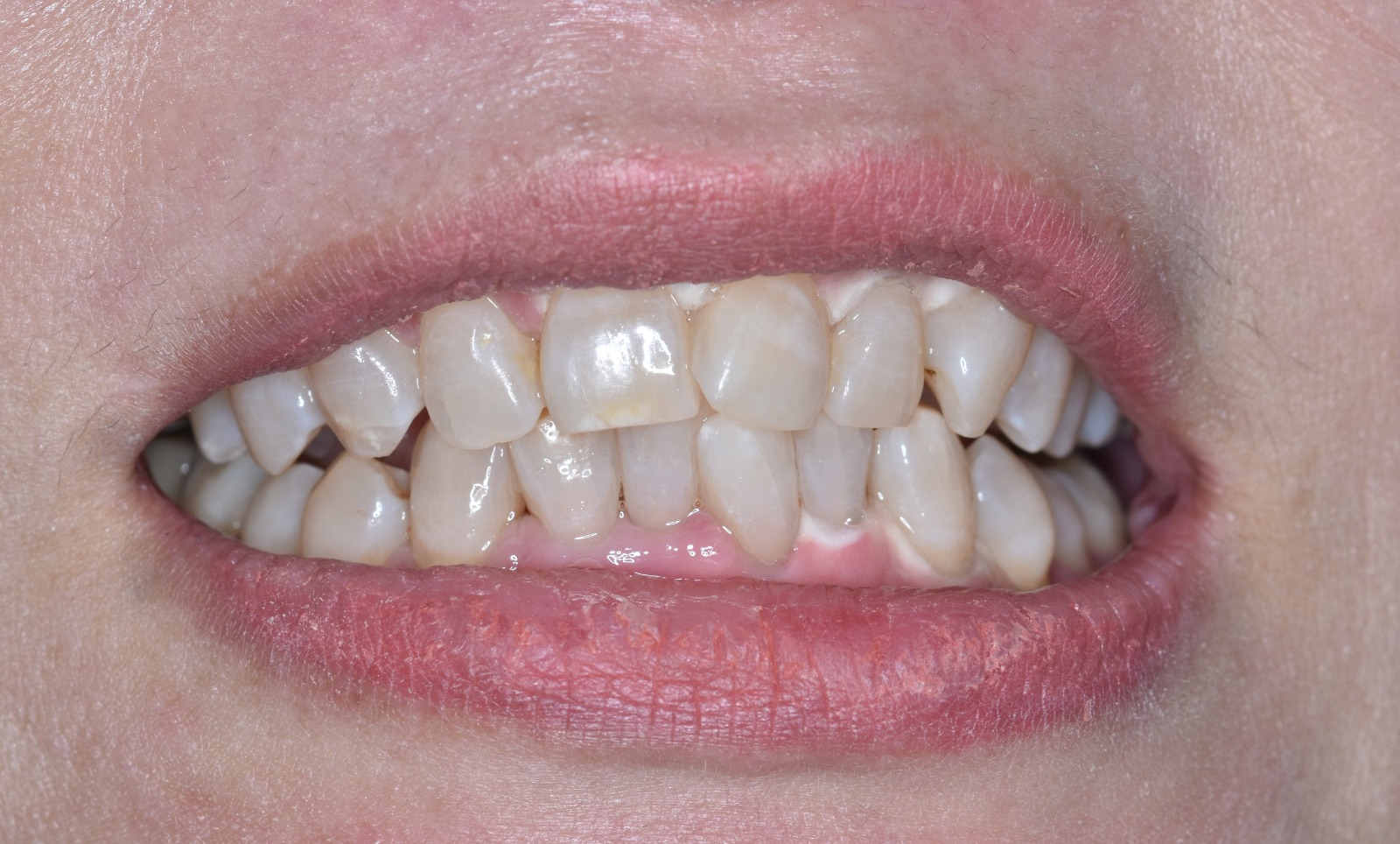 After Teeth Whitening