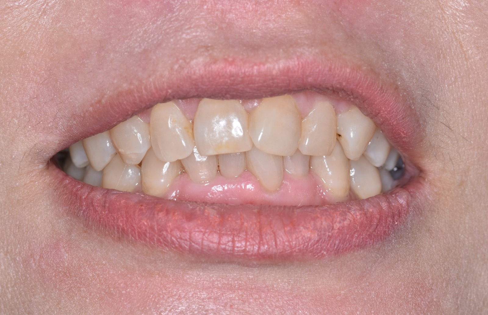 Before Teeth Whitening